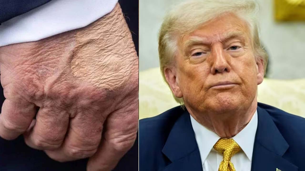 Trump Diagnosed With Common Vein Condition